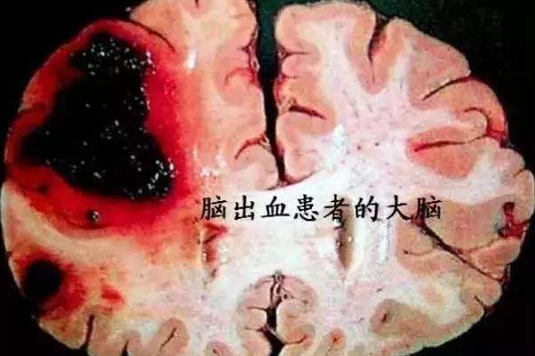 没有高血压会脑出血吗？