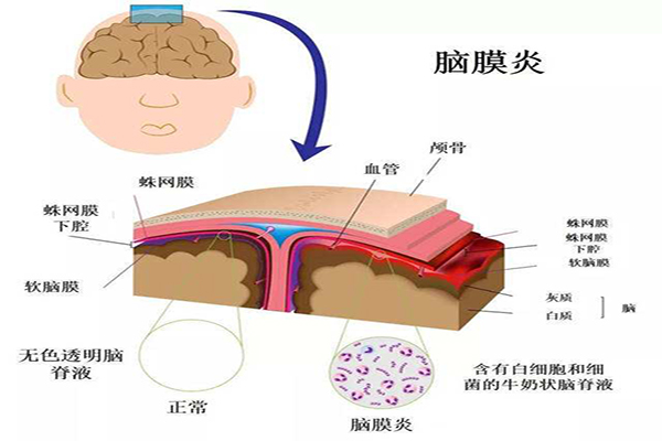 病毒性脑炎严重吗？